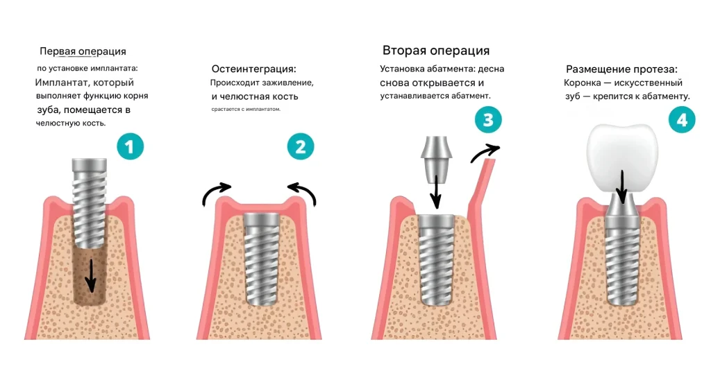 Двухэтапная (классическая) имплантация зуба