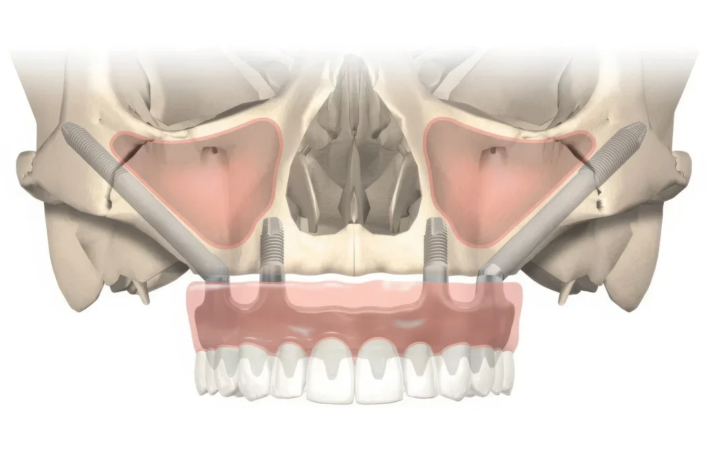 Скуловые импланты Zygoma в Москве