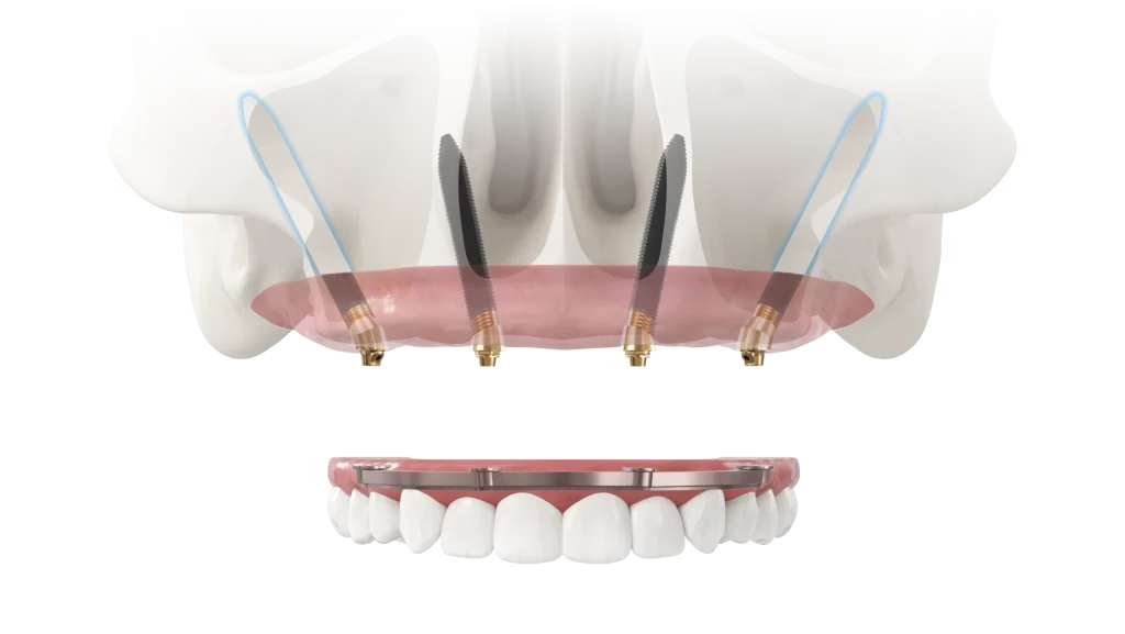 All-on-4: восстановление всех зубов «за 1 день» — этапы, сроки, ограничения