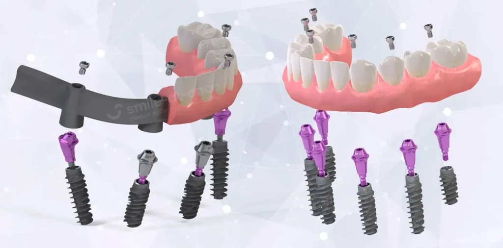 Pro Arch от Straumann