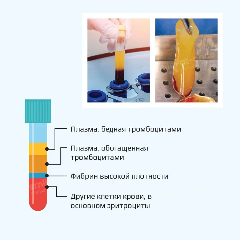 Рисунок - создание PRF-мембраны для имплантации