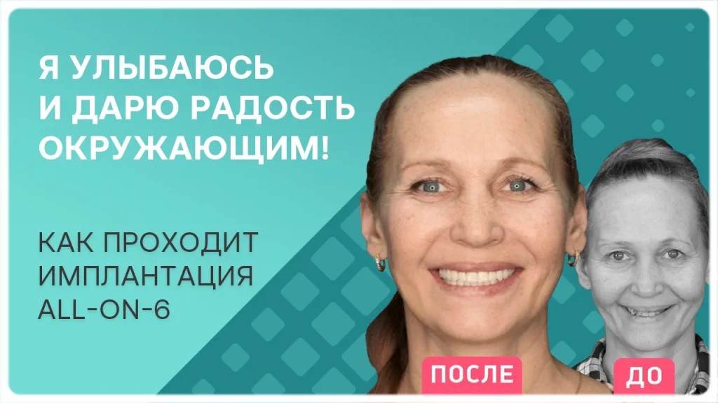 Видео отзыв после имплантации зубов - пациент Татьяна Анатольевна