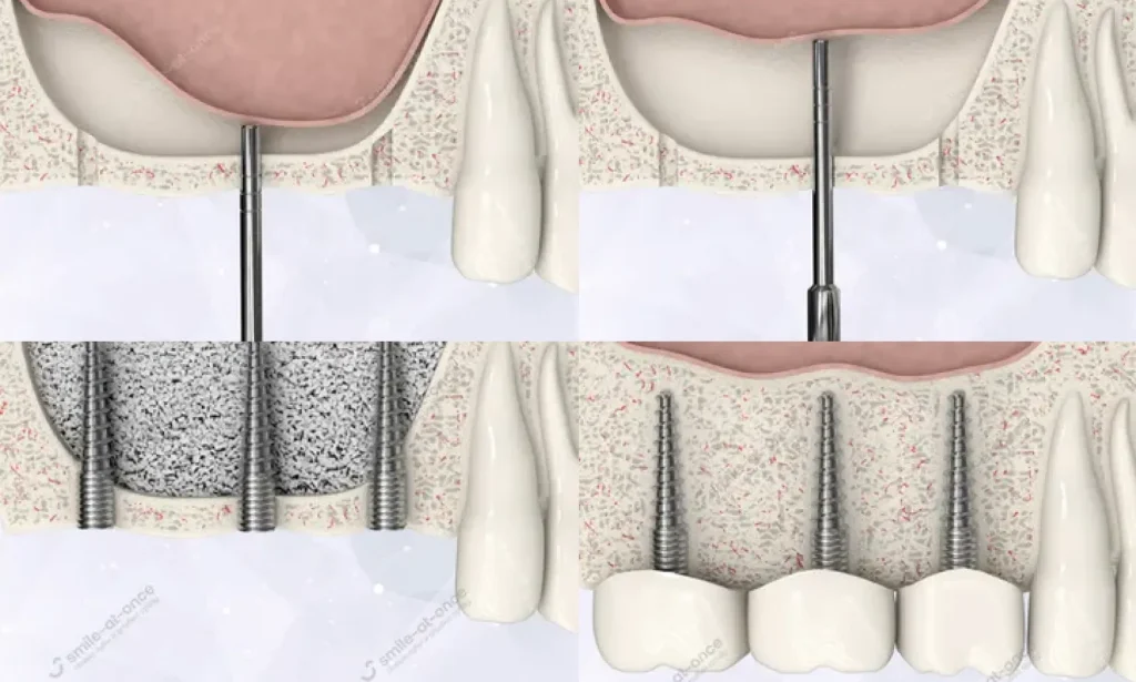 Закрытый синус-лифтинг